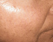 Vビーム治療後の写真