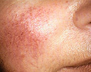 Vビーム治療前の写真