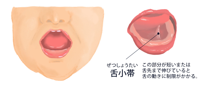 舌小帯短縮症イラスト