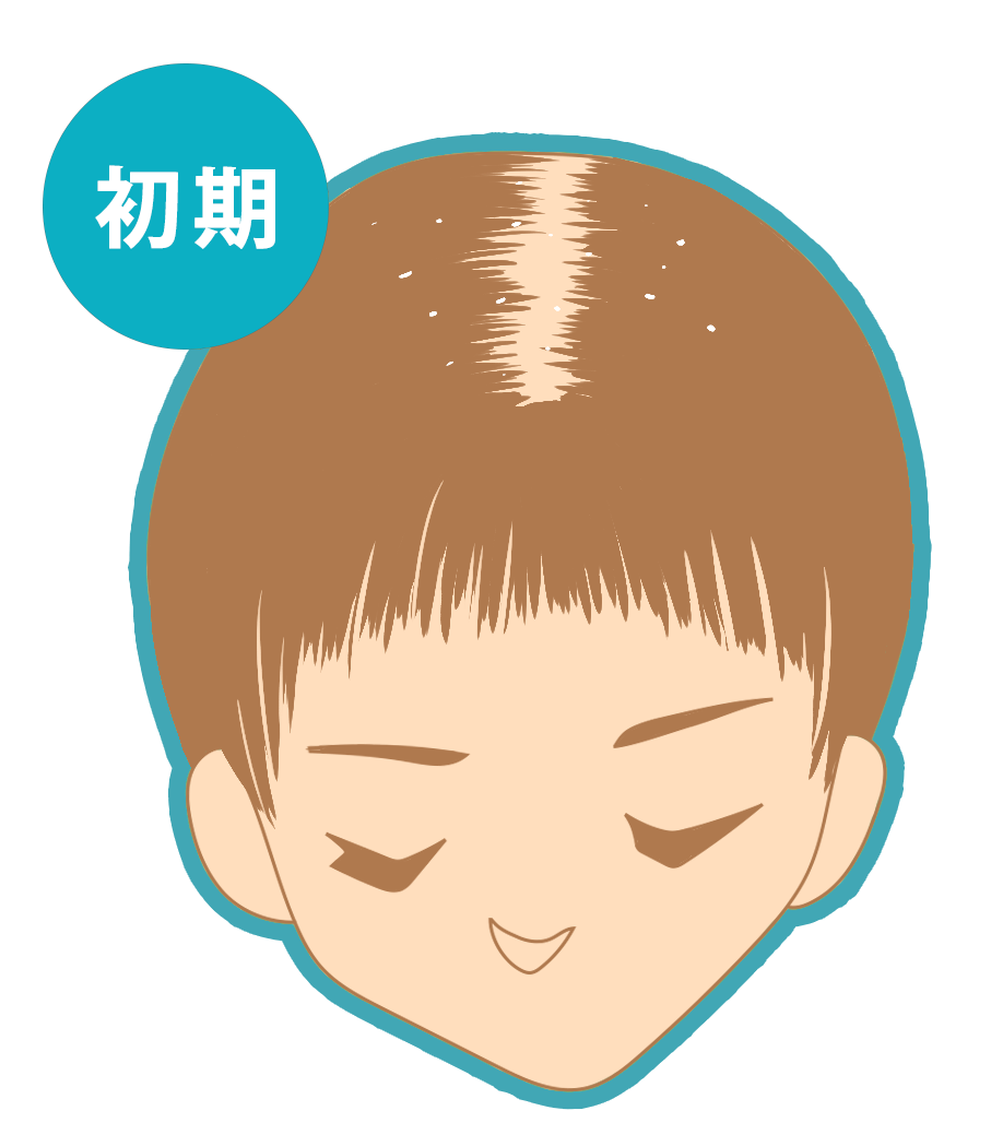 粃糠（ひこう）性脱毛症