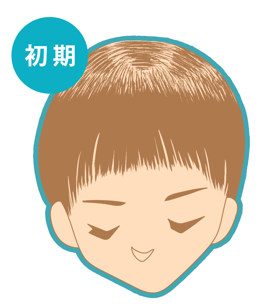 びまん性脱毛症