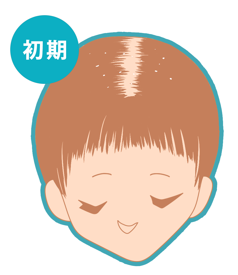 脂漏（しろう）性脱毛症、粃糠（ひこう）性脱毛症