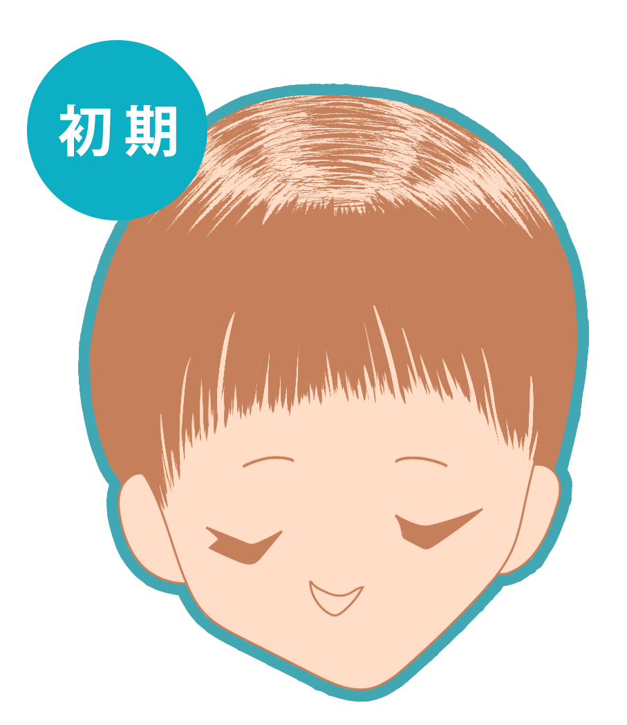 びまん性脱毛症