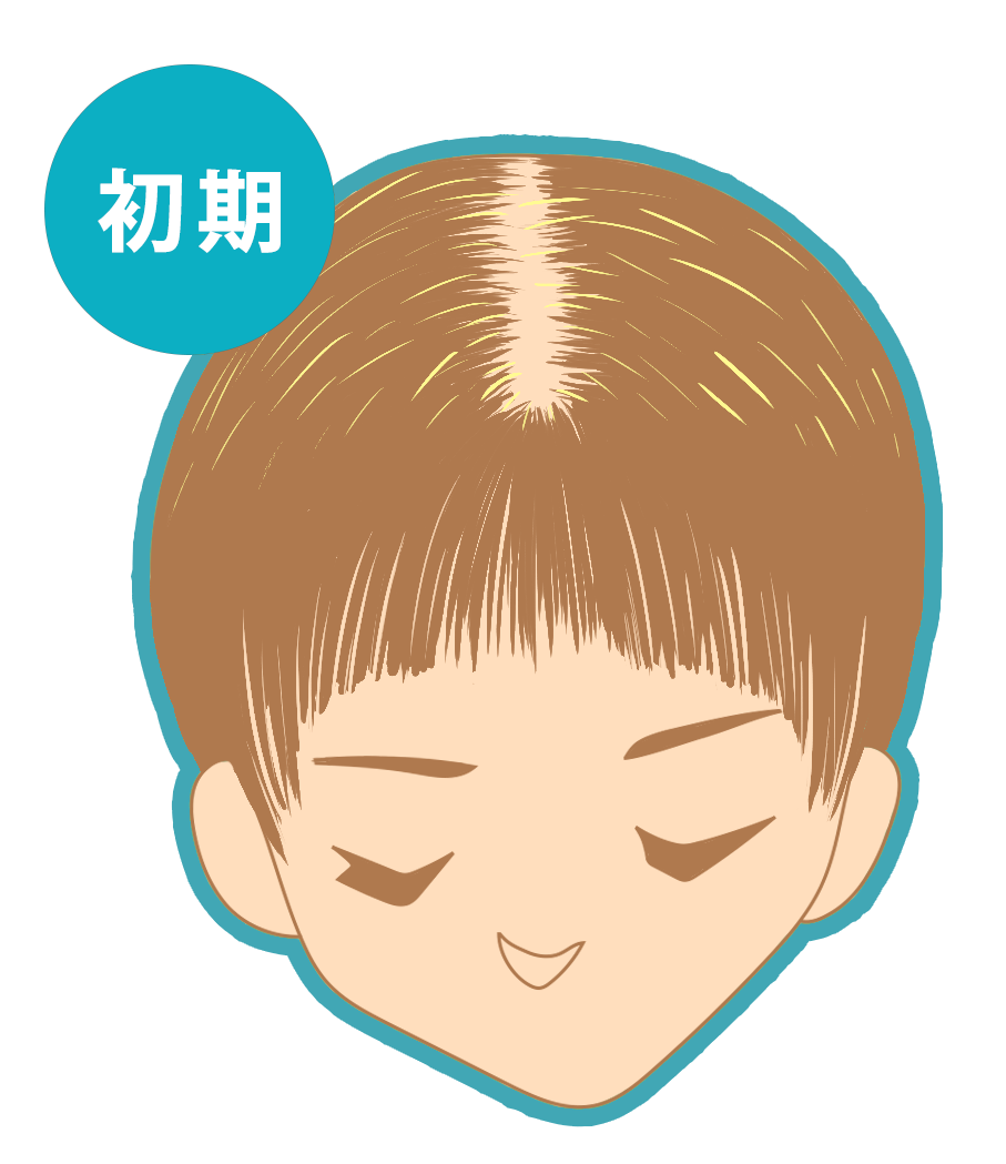 脂漏（しろう）性脱毛症